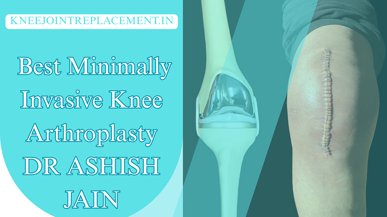 Best Minimally Invasive Knee Arthroplasty in Delhi NCR