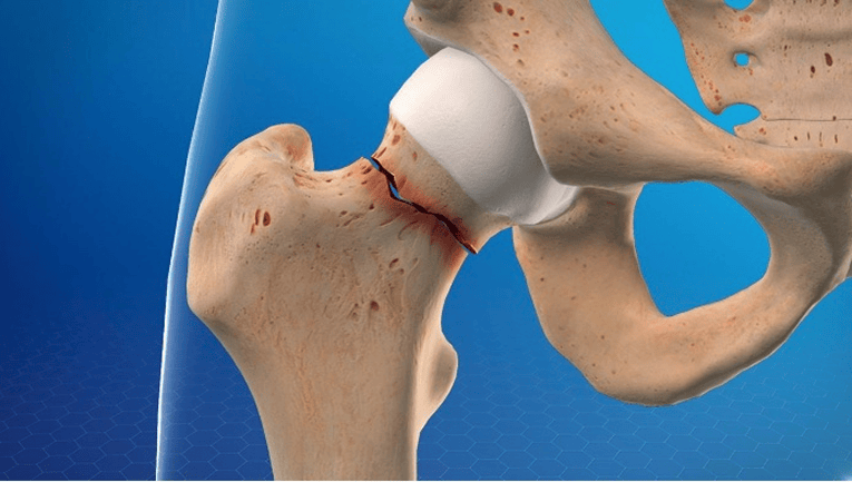 Fracture Fixation: Types, Procedures, and Recovery Guide