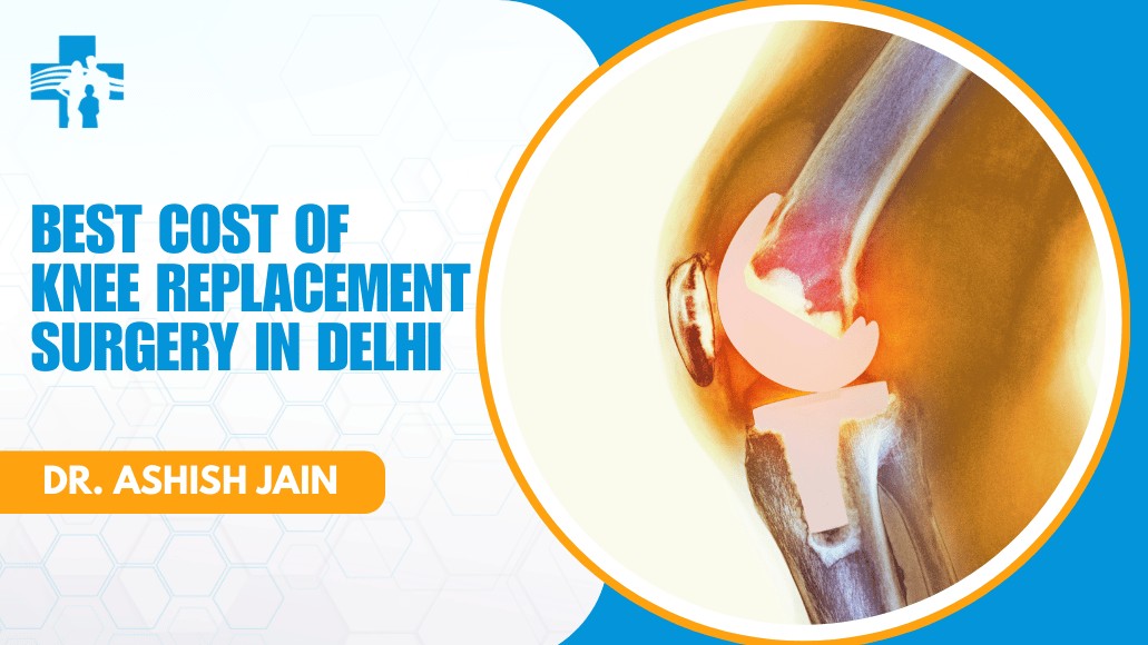 Cost of Knee Replacement Surgery in Delhi