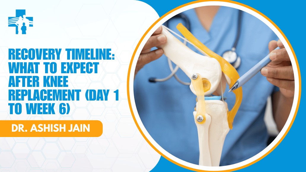 Knee replacement recovery time